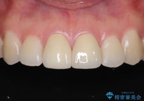 セラミッククラウンによる前歯の形態改善