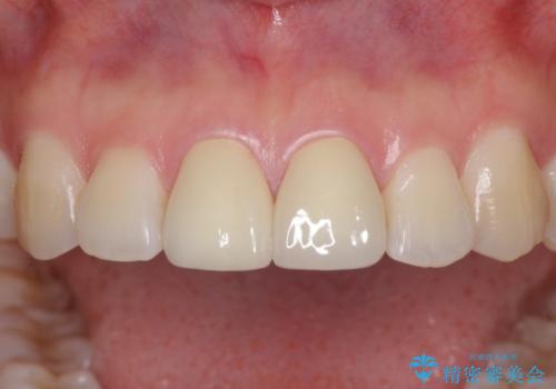 セラミッククラウンによる前歯の形態改善の治療後