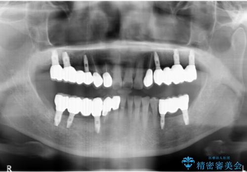 [入れ歯を外したい]  全顎的インプラント・補綴治療の治療後