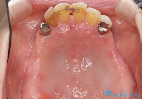 [入れ歯を外したい]  全顎的インプラント・補綴治療の治療前
