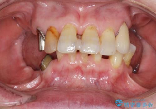 [入れ歯を外したい]  全顎的インプラント・補綴治療の治療前