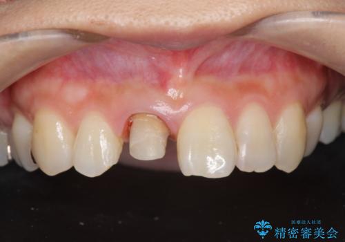 前歯の色を揃えたい　上顎前歯オールセラミックジルコニアクラウン治療の治療中