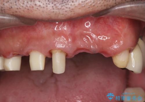 [ 重度虫歯治療 ]　ブリッジ・インプラントによる咬合・審美回復②の治療中