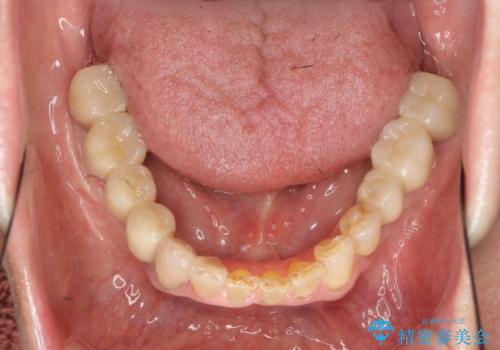 [入れ歯を外したい]  全顎的インプラント・補綴治療の治療後