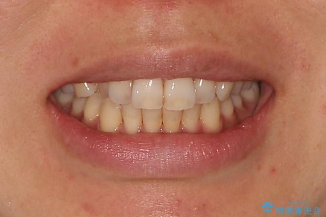 前歯のクロスバイトをインビザラインとマイクロインプラントのコンビネーションで短期間に治すの治療前（顔貌）