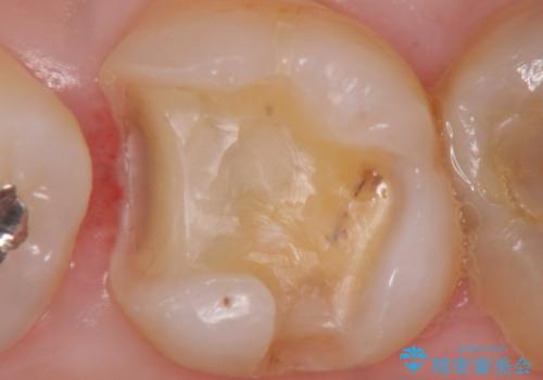 銀歯下の虫歯の再発　セラミックインレー修復の治療中