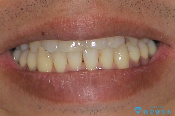 前歯のガタガタ 反対咬合を短期間に改善　インビザライン治療の治療後（顔貌）