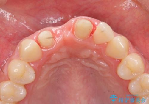 歯ぐきの凹みが気になる　前歯部ブリッジ審美改善の治療中