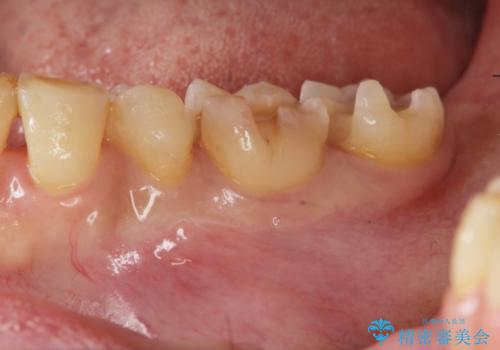 銀歯の下に再発した虫歯 　セラミックインレー修復の治療中