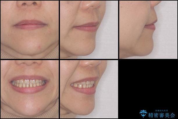 前歯のでこぼこをきれいに　インビザラインによる矯正治療の治療後（顔貌）