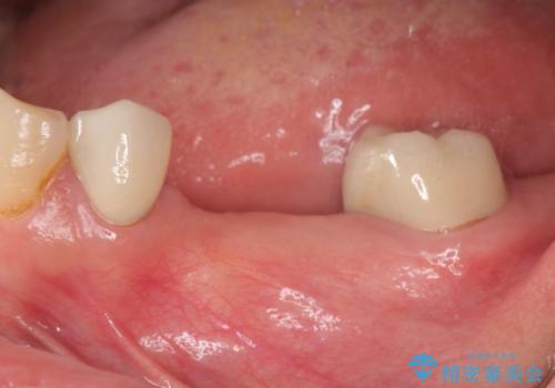 奥歯　インプラントによる咬合回復の治療前