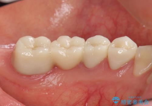 銀歯だらけの歯をセラミックで白くしたいの治療後