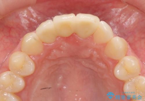 歯ぐきの凹みが気になる　前歯部ブリッジ審美改善の治療後
