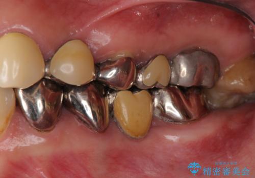 銀歯だらけの歯を白くの治療前