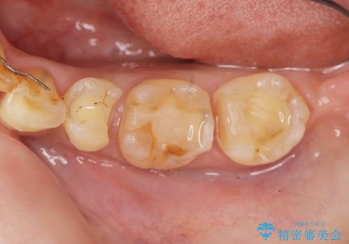 銀歯の下に再発した虫歯 　セラミックインレー修復の治療中