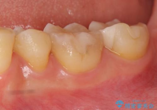 銀歯の下に再発した虫歯 　セラミックインレー修復の治療後