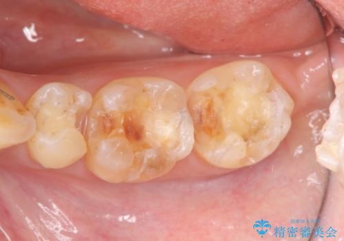 銀歯の下に再発した虫歯 　セラミックインレー修復の治療前