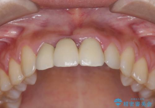 歯ぐきの凹みが気になる　前歯部ブリッジ審美改善の治療前