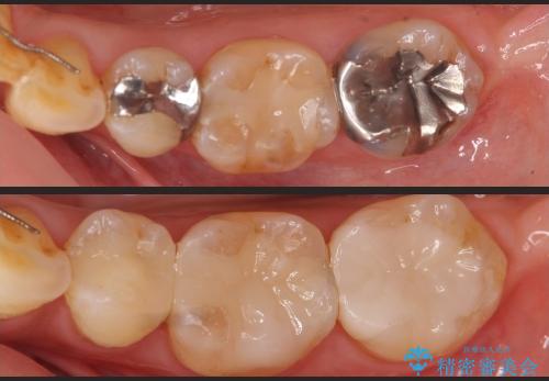 銀歯の下に再発した虫歯 　セラミックインレー修復