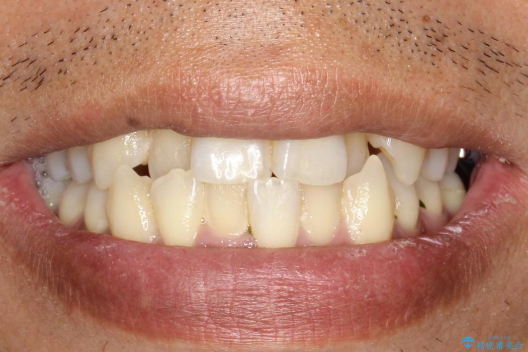 前歯のガタガタ 反対咬合を短期間に改善　インビザライン治療の治療前（顔貌）