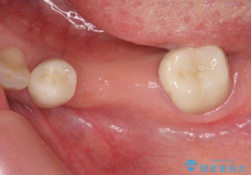 奥歯　インプラントによる咬合回復の治療前