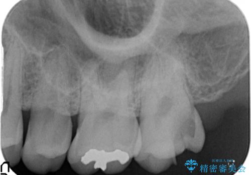 深い虫歯の治療　適合のいいゴールドインレーの治療前