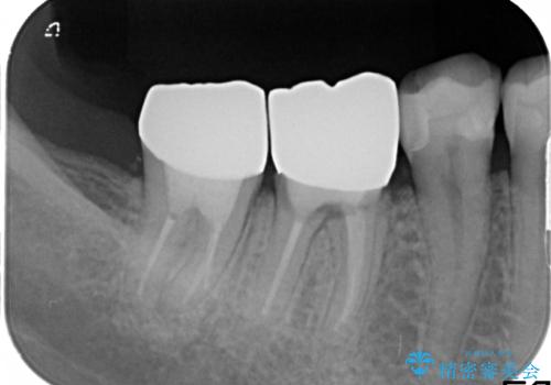 奥歯のセラミックのやり直し・土台からの治療後