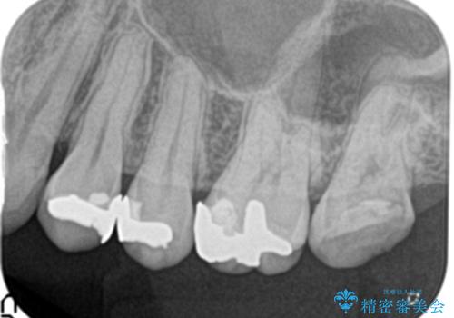 銀歯下の虫歯の再発　セラミックインレー修復の治療前