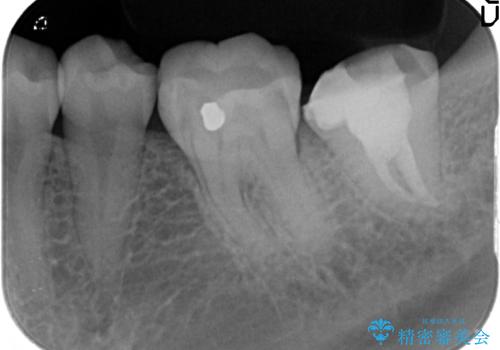 ゴールドクラウン(PGAクラウン)　隙間のない歯の補綴の治療前