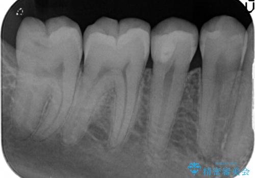 虫歯による大きな欠損　セラミックインレー修復の治療後