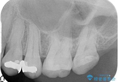 銀歯下の虫歯の再発　セラミックインレー修復の治療後