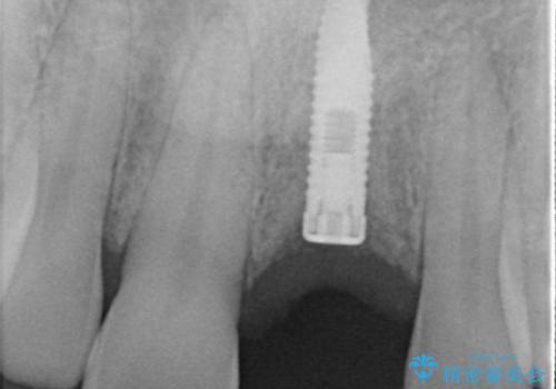 上の前歯が割れた　インプラントによる審美的・機能的回復の治療中