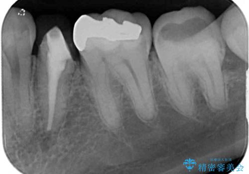 親知らず抜歯と下奥歯の被せものの治療前