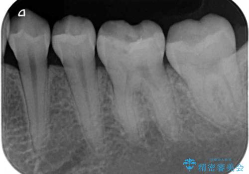 奥歯の審美的なむし歯治療　の治療前