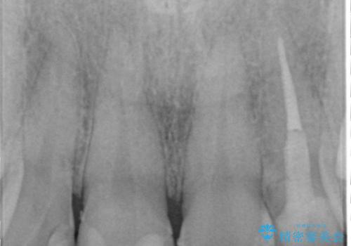 前歯の大きい虫歯の治療後