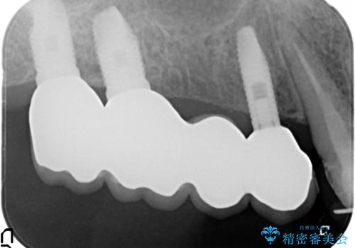 臼歯の遊離端欠損　インプラント補綴の治療後