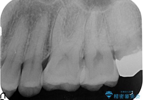 銀歯から白い歯への治療後