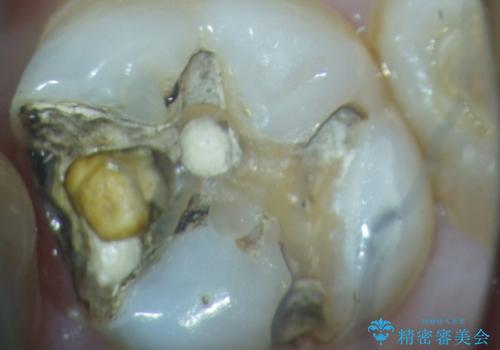 銀歯下の虫歯の再発　セラミックインレー修復の治療前