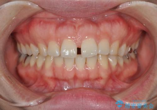 すきっ歯のワイヤー矯正による治療の治療前