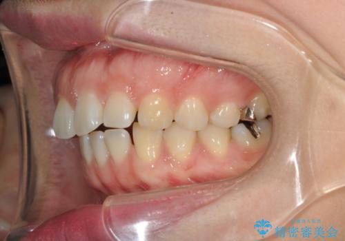 すきっ歯のワイヤー矯正による治療の治療前