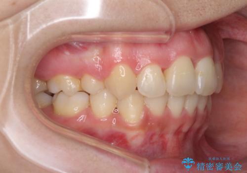 重度の前歯のガタガタの矯正治療の治療後