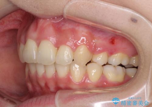 重度の前歯のガタガタの矯正治療の治療後