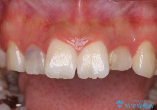 変色した前歯をオールセラミッククラウンで自然な色にの治療前
