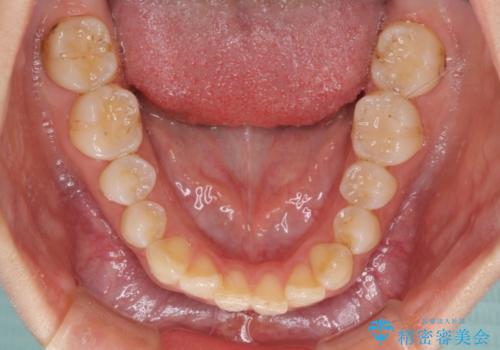 奥歯の審美的なむし歯治療　の治療前
