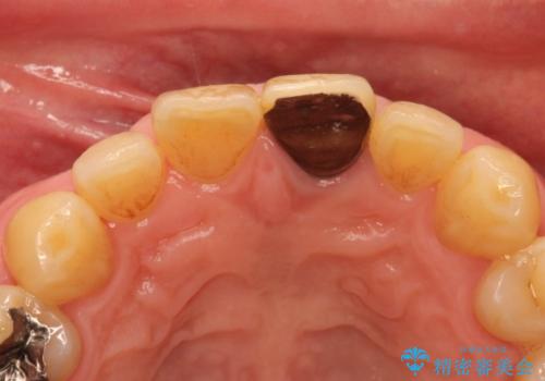 上の前歯が割れた　インプラントによる審美的・機能的回復の治療前