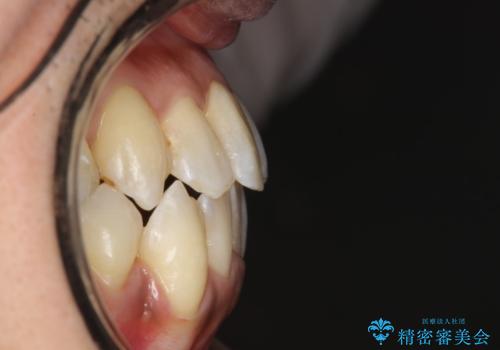 前歯のガタガタ 反対咬合を短期間に改善　インビザライン治療の治療後