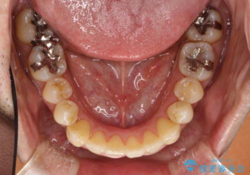 前歯のガタガタ 反対咬合を短期間に改善　インビザライン治療の治療後