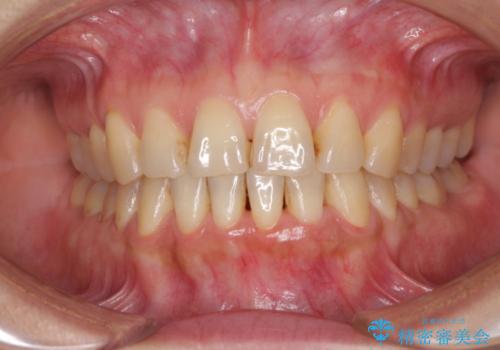前歯のでこぼこをきれいに　インビザラインによる矯正治療