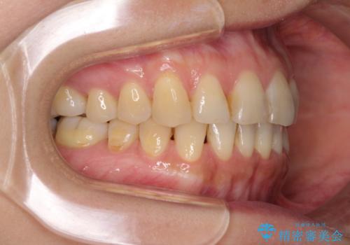 前歯のでこぼこをきれいに　インビザラインによる矯正治療の治療後