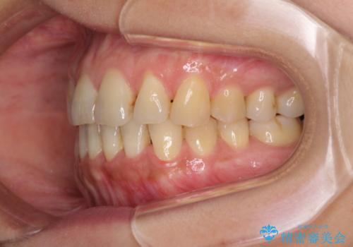 前歯のでこぼこをきれいに　インビザラインによる矯正治療の治療後